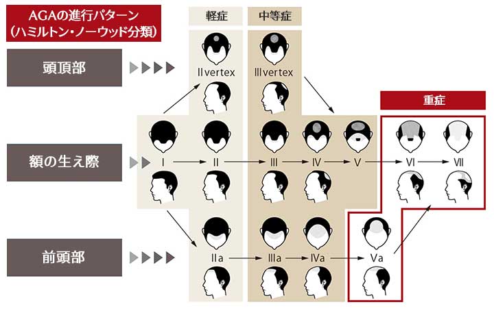 AGA（男性型脱毛症）が進行するパターンとは？ 