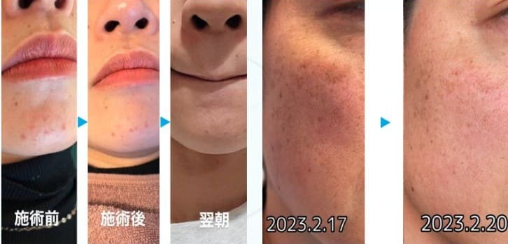 エクソソーム注射による肌質改善症例１
