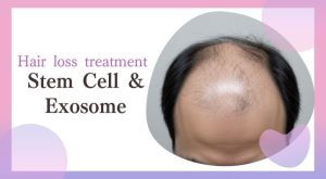 Stem Cell–derived Exosome Hair Restoration in Tokyo,Japan