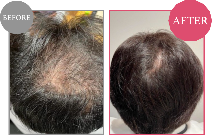 Before and After of Exosome Treatment(2)