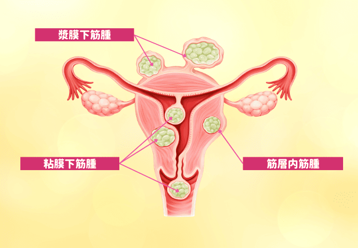 子宮筋腫とは?