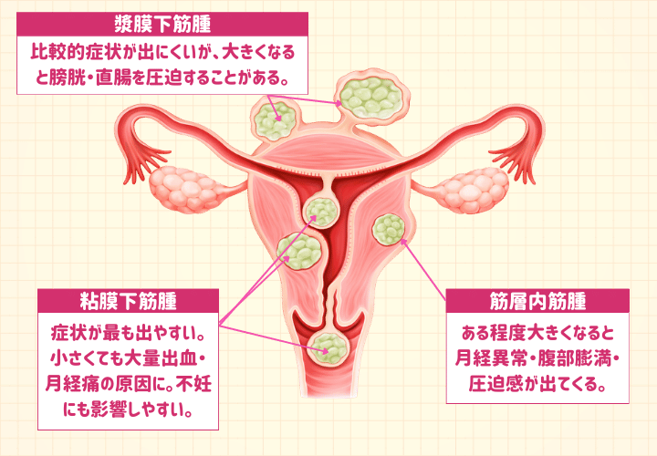 種類で変わる!子宮筋腫の位置と症状の関係